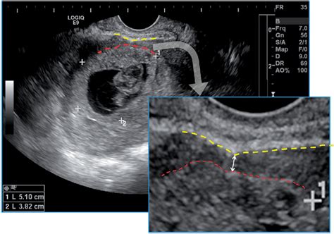 measurement of lower uterine segment thickness|myometrial thickness.